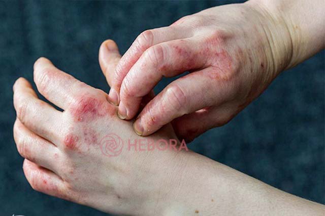 Tìm hiểu tại sao da tay bị nhăn khi gặp nước lại liên quan đến bệnh Eczema?